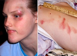 Jennifer Howson was restrained dozens of times in her Kemp public school, often sustaining injuries like these. 