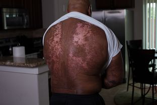 Glenn Johnson, 55, was injured in a smelting accident near Amarillo in 1997 when a furnace filled with molten metal exploded, crushed him and left major burns across 90 percent of his body. Johnson struggled to get compensation for his on-the-job injuries.